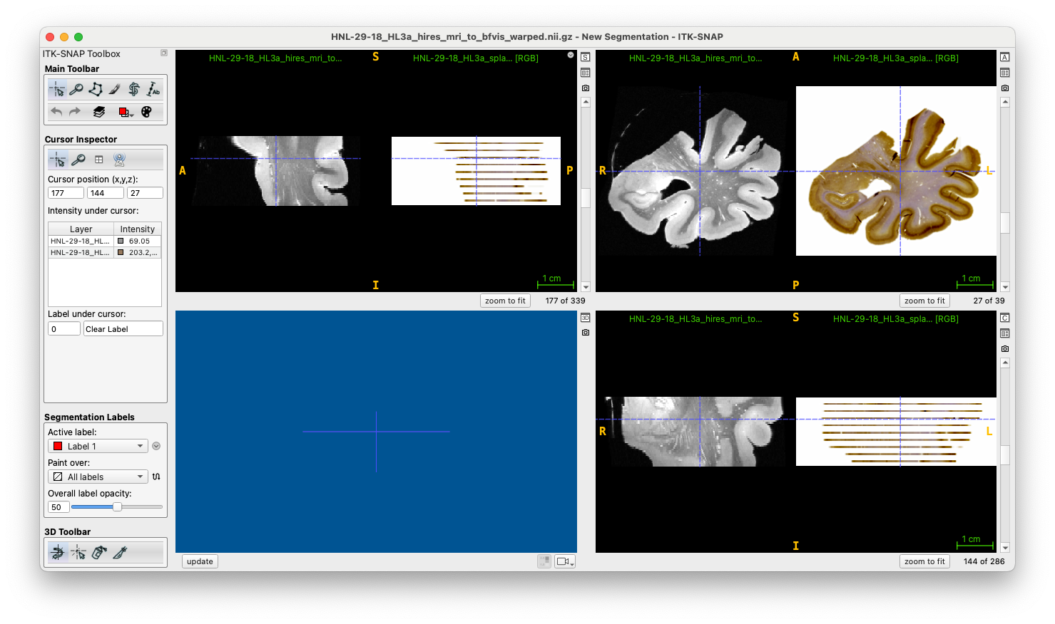 IHC reconstructed in 3D
